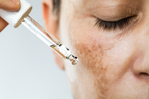 Hyperpigmentation: Understanding and Addressing Dark Spots