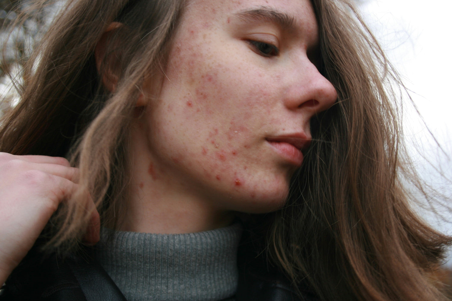 Is Incellderm Safe for Sensitive or Acne-Prone Skin? Everything You Need to Know