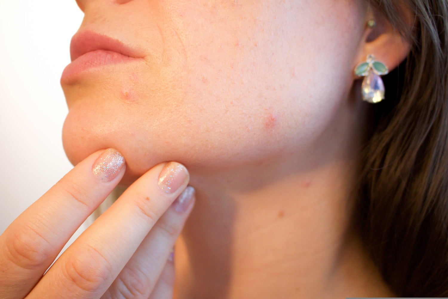 Incellderm Purging vs. Breakouts: How to Tell if It's Purging, Irritation, or an Allergic Reaction Part 1